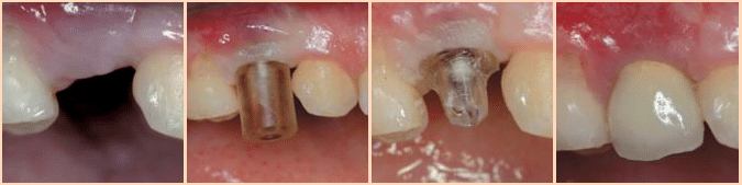 Meisinger Easy-Handling-Abutments KABUTSEL002
