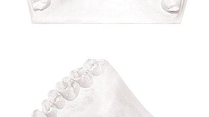 GARRECO Dental Plaster 25lb or 50lb, ALL TYPES
