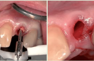 Meisinger Bone Management Benex - Control Professional Root Extraction System #BBEPR