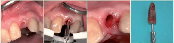 Meisinger Bone Management Benex - Control Professional Root Extraction System #BBEPR