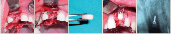 Meisinger Bone Management Transfer-Control Bone Replacing System
