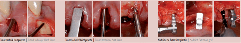 Meisinger Tissue-Control