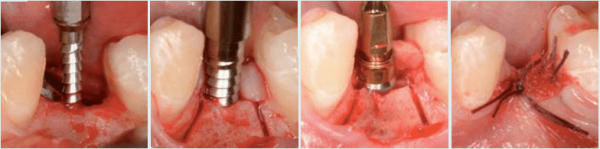 Meisinger Bone Management Split-Control 12mm Bone Spreading and Condensing System